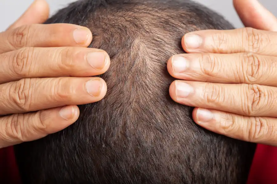 Managing Hair Thinning With Targeted Alopecia Treatments in Inglewood, CA Managing Hair Thinning With Targeted Alopecia Treatments in Inglewood, CA