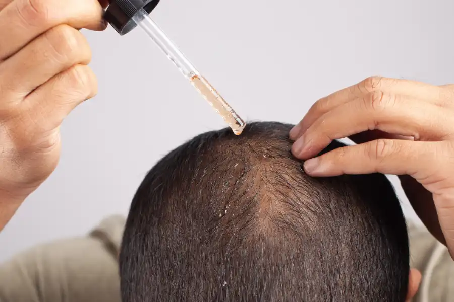 Reliable Alopecia Treatment Inglewood, CA Reliable Alopecia Treatment Inglewood, CA